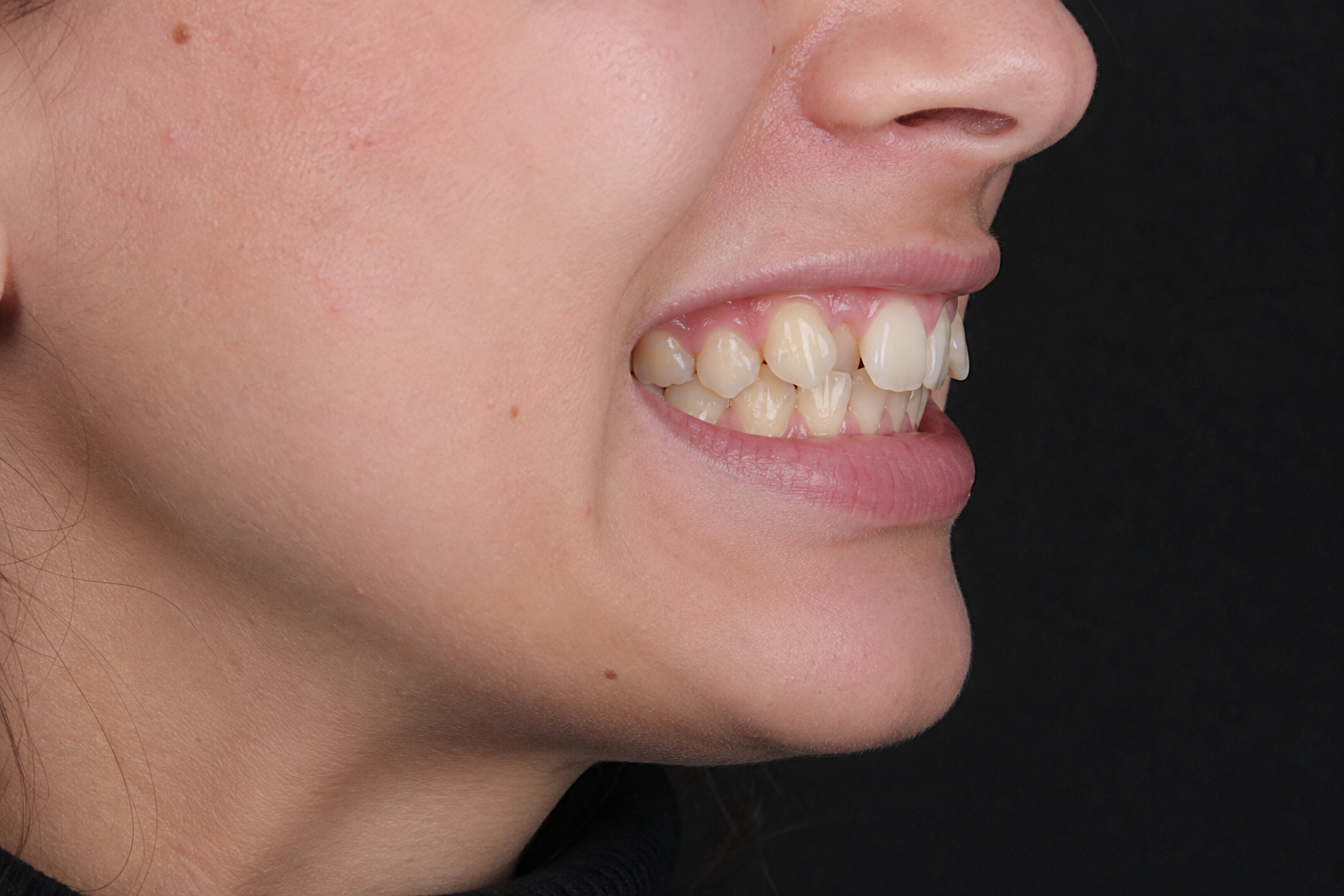 Aligners Before