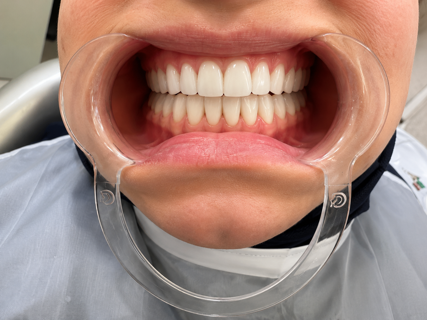 Implant After