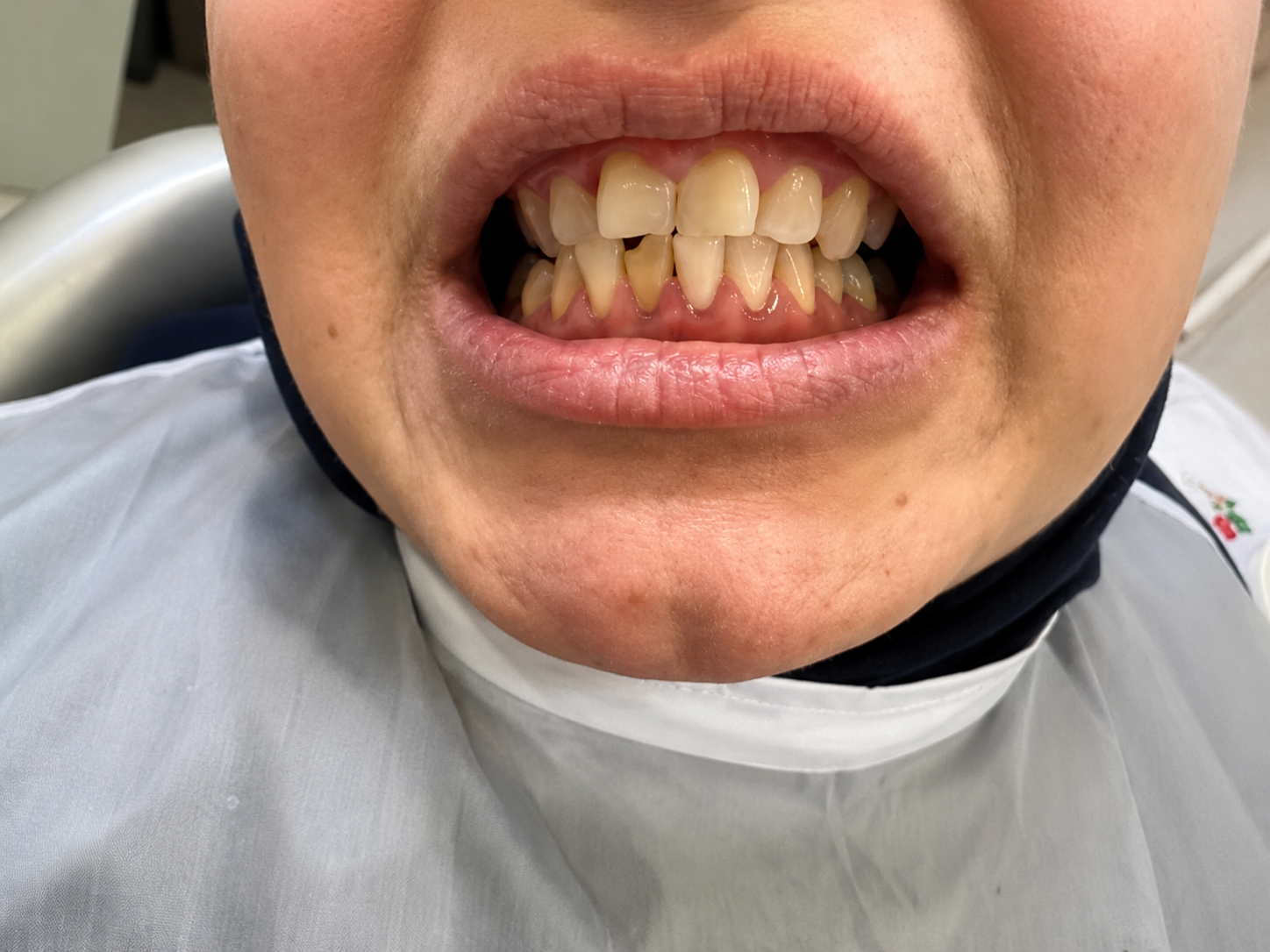 Implant Before