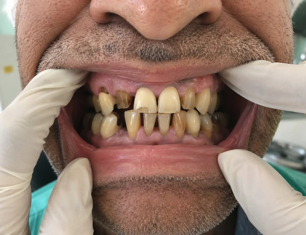Ceramic Crowns Before