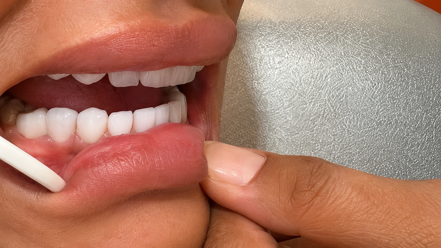 Veneers After