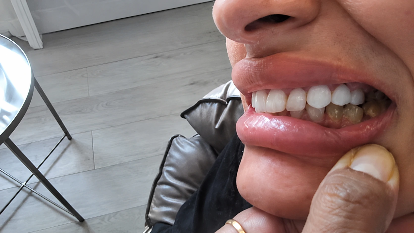 Veneers Before