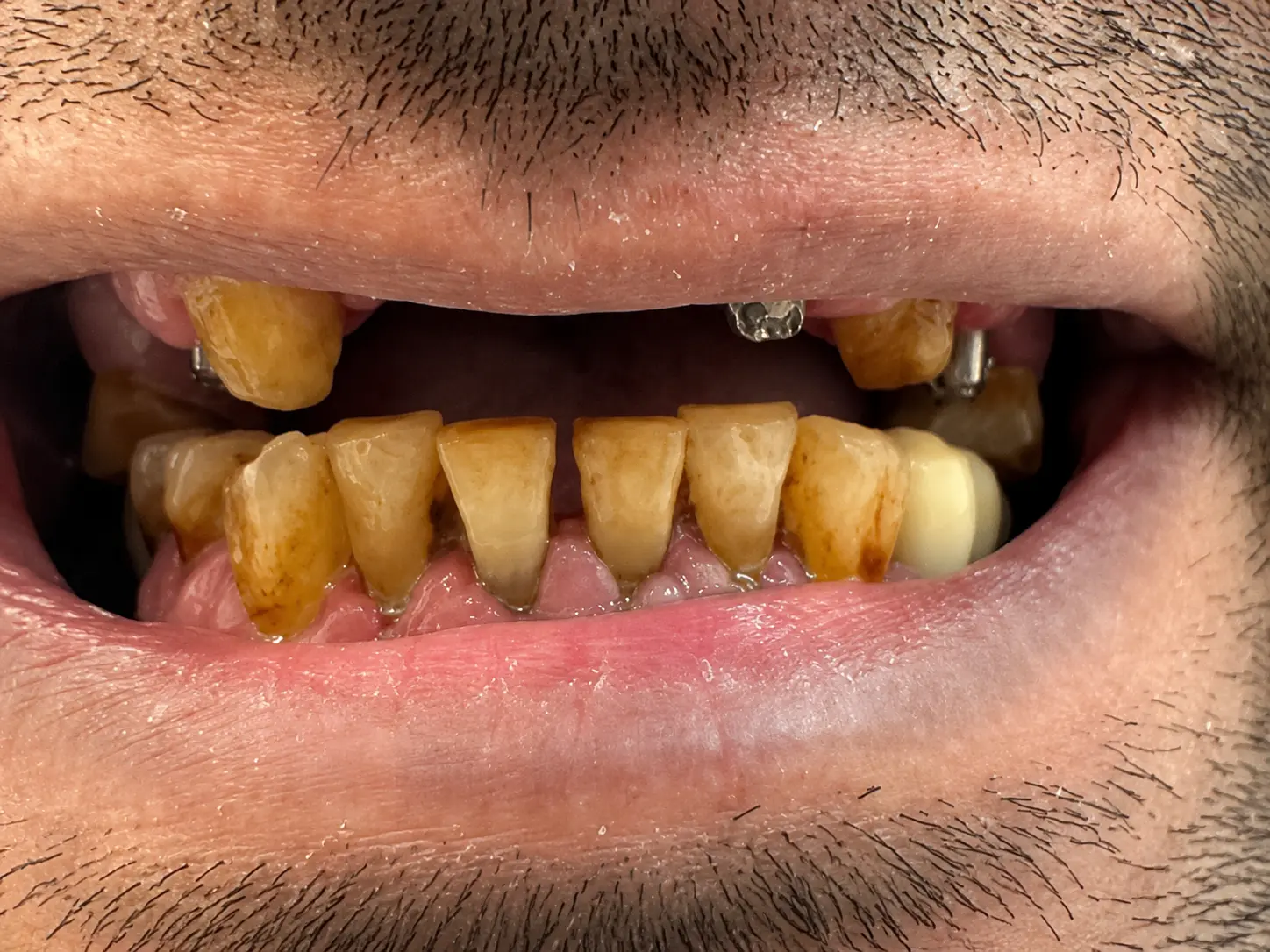 Crowns Before
